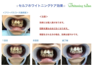 【ホワイトニングケア効果】