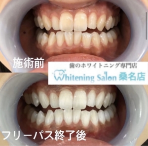 理想の白い歯へ♪