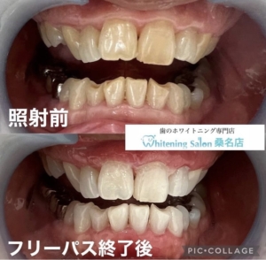 【何歳だって白い歯の素敵な笑顔になれます！】