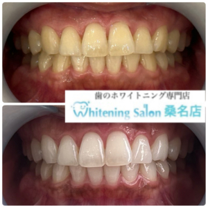 【白い歯を手に入れてみてください】