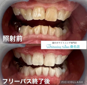 【痛み無しのホワイトニング】