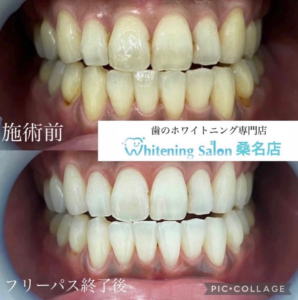【白い歯には好印象を与える効果あり!?】