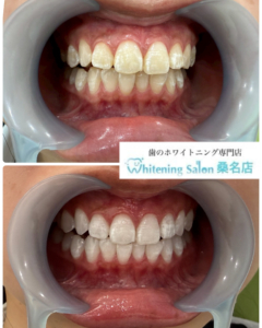 【たった3週間で白い歯が手に入る】