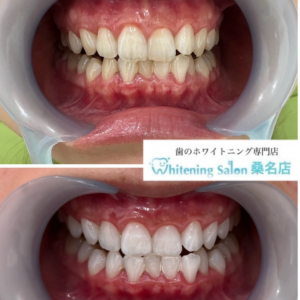 【制限のないホワイトニング】