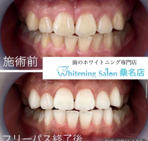 【ホワイトニング経験ありますか】