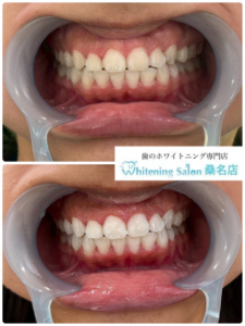【綺麗な歯を手に入れました】