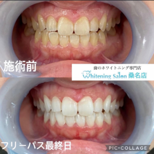 【適切な歯ブラシ交換時期】