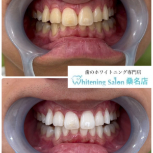 【自信を持てる白い歯を目指しましょう！】