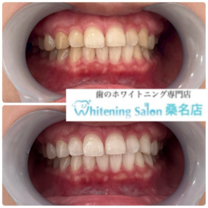 【男性の方もホワイトニング急増】