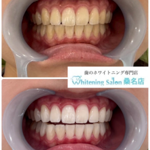 【白い歯を手に入れましょう！】