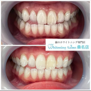 【当店で歯を白くしませんか!?】