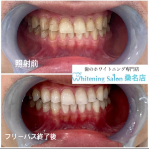 【ホワイトニングデビュー】