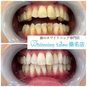 白い歯を手に入れましょう