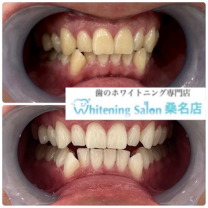 【黄ばみが取れ綺麗な歯へ】