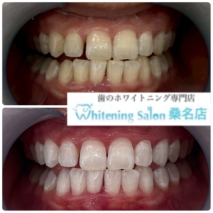 【ホワイトニングするポイント】