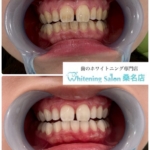 【黄ばみが綺麗に取れました】