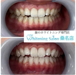 【白い歯で美意識高く】