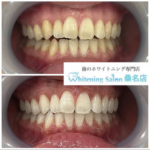 【美しい歯を手に入れてください♪】