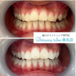 【白い歯を手に入れましょう！】