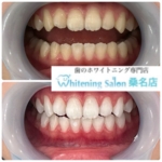 【学生さんの白い歯もサポートします！】