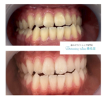 【ご新規様向けクーポンでお得にホワイトニング】