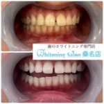 【白い歯を手に入れましょう】