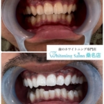 【綺麗な歯を保つには】