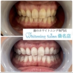 【美しい歯を手に入れませんか!?】