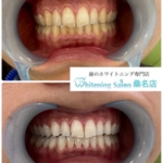 【3週間で美しい歯に☆】