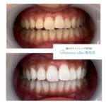 【黄ばみの原因とは？】