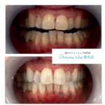 【いつでも白い歯は取り戻せる！】