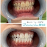 黄ばみを無くすには