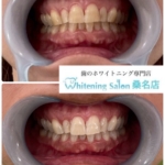 【大人気コースで白い歯GET】